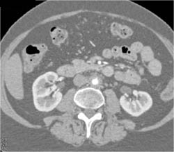 Retroperitoneal Fibrosis - CTisus CT Scan