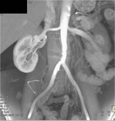 Retroperitoneal Fibrosis - CTisus CT Scan