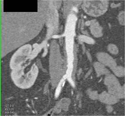 Retroperitoneal Fibrosis - CTisus CT Scan