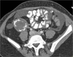 Failed Renal Transplant - CTisus CT Scan