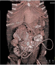 Catheter for Dialysis - CTisus CT Scan