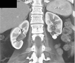 Scarring Lower Pole Left Kidney With Calcification - CTisus CT Scan