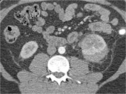 Acute Pyelonephritis - CTisus CT Scan