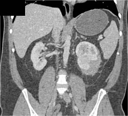 Acute Pyelonephritis - CTisus CT Scan