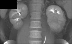 Acute Pyelonephritis - CTisus CT Scan