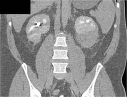 Acute Pyelonephritis - CTisus CT Scan