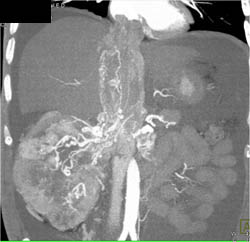 Renal Cell Carcinoma Invades Right Renal Vein, Left Renal Vein, IVC and Extends Into Right Atrium - CTisus CT Scan