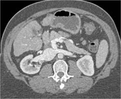 Splenorenal Shunting But to Right Renal Vein- Note Incredible Collaterals - CTisus CT Scan