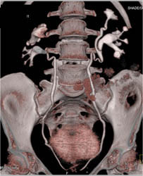 Duplicated Collecting System and One Distal Ureter- Nice 3D Bladder View - CTisus CT Scan