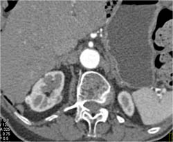 Several Small- Less Than 1 Cm- Renal Cell Carcinomas in the Right Kidney and Left - CTisus CT Scan