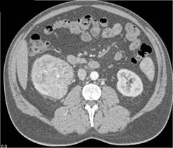 Renal Cell Carcinoma - CTisus CT Scan