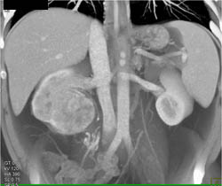 Renal Cell Carcinoma - CTisus CT Scan