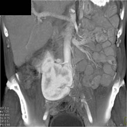Crossed Fused Renal Ectopia - CTisus CT Scan