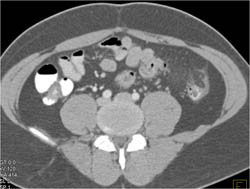 Hazy Mesentery - CTisus CT Scan