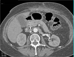 FMD - Fibromuscular Dysplasia of the Left Renal Artery - CTisus CT Scan