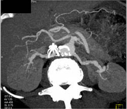 Hypervascular Renal Cell Carcinoma Invades the Left Renal Vein - CTisus CT Scan