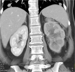 Renal Vein Invasion Causes Delayed Left Renal Function With Persistent Corticomedullary Differentiation - CTisus CT Scan