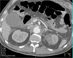 Renal Infarction - CTisus CT Scan