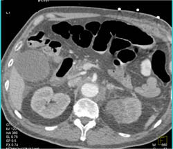 Renal Infarction - CTisus CT Scan