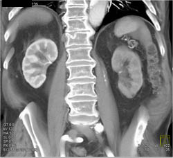 Delayed/decreased Left Renal Enhancement Due to Renal Artery Stenosis and Compressed True Lumen By False Lumen - CTisus CT Scan