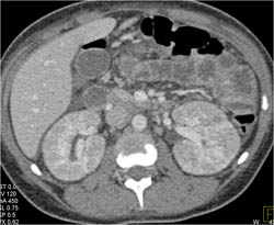 Infiltration of Both Kidneys- the Final Diagnosis Was Acute Pyelonephritis - CTisus CT Scan