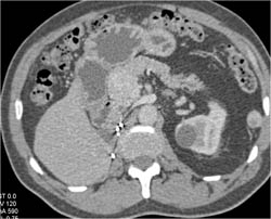 Right Nephrectomy Bed - CTisus CT Scan