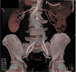 Dilated Calyces Left Kidney - CTisus CT Scan