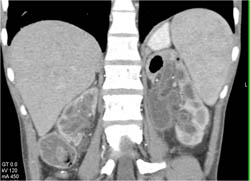 Ureteropelvic Junction (UPJ) Obstruction With Dilated Renal Pelvis and Loss of Cortex - CTisus CT Scan