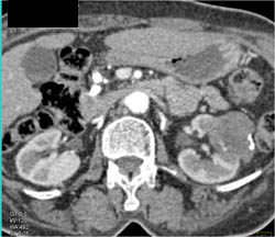 Cystic Renal Cell Carcinoma With Rim Calcification - CTisus CT Scan