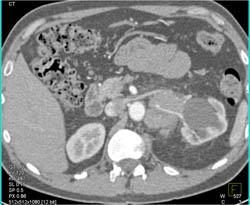 Germ Cell Tumor Obstructs the Left Kidney - CTisus CT Scan