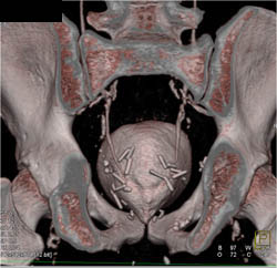 Ct Cystogram S/P Prostatectomy - CTisus CT Scan