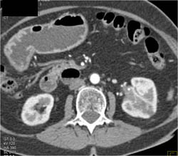 Transitional Cell Carcinoma in Left Kidney - CTisus CT Scan