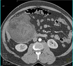 Liposarcoma Pushes on the Kidney - CTisus CT Scan