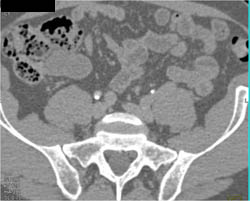 Subtle Right Urethral Cancer - CTisus CT Scan