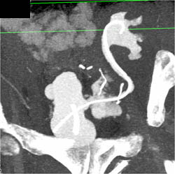 Neobladder in 3D With Leak - CTisus CT Scan