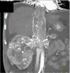 Renal Cell Carcinoma Extends Into Right Renal Veins IVC and Right Atrium - CTisus CT Scan