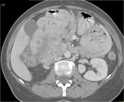 Renal Cell Carcinoma - CTisus CT Scan