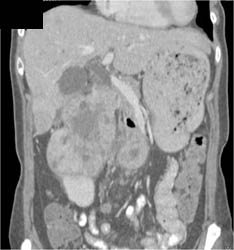 Renal Cell Carcinoma - CTisus CT Scan