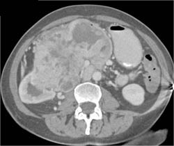 Renal Cell Carcinoma - CTisus CT Scan