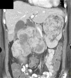 Renal Cell Carcinoma - CTisus CT Scan