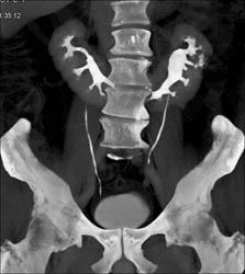 Horseshoe Kidney - CTisus CT Scan