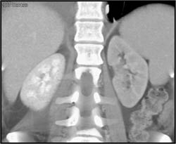 Acute Pyelonephritis Left Kidney - CTisus CT Scan