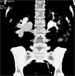 Ureteropelvic Junction (UPJ) on the Right Due to Crossing Vessel - CTisus CT Scan