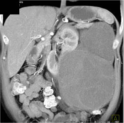 Cystic Renal Cell Carcinoma (RCC) - CTisus CT Scan