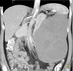 Cystic Renal Cell Carcinoma (RCC) - CTisus CT Scan