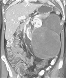 Cystic Renal Cell Carcinoma (RCC) - CTisus CT Scan