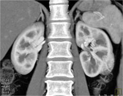 Subtle Left Renal Cell Carcinoma (RCC) - CTisus CT Scan