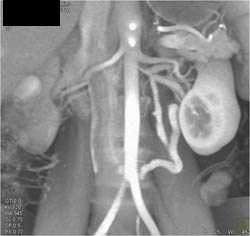 Prominent Left Gonadal Vein - CTisus CT Scan