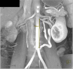 Prominent Left Gonadal Vein - CTisus CT Scan