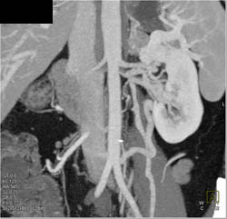 Prominent Left Gonadal Vein - CTisus CT Scan